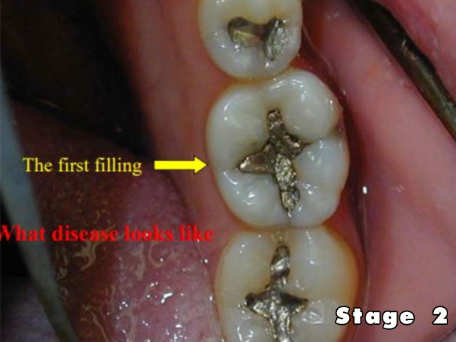 圖中是第一次補牙的樣子